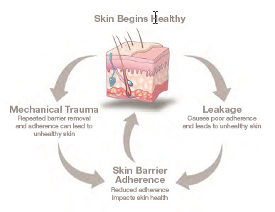 healthy-peristomal-skin-cycle-ostomy-illustration